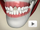 ID Dental - Missing Tooth - Maryland Bridge