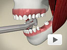 ID Dental - Missing Tooth - Bridge