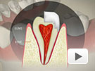 ID Dental - Cusp Fracture Crown Lengthening