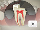 ID Dental - Crown Tooth Decay