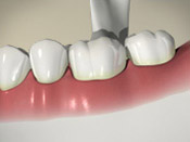 ID Dental - How Teeth Decay