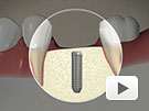 ID Dental - Implant Cemented Crown