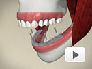 ID Dental - Implant Supported Denture