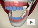 ID Dental - Laser Teeth Whitening