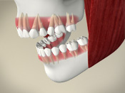 ID Dental - Overview of Orthodontic Problems