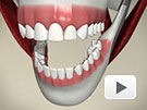 ID Dental - Veneer Close Space