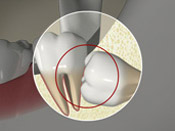 ID Dental  - Wisdom Teeth Horizontal Impaction